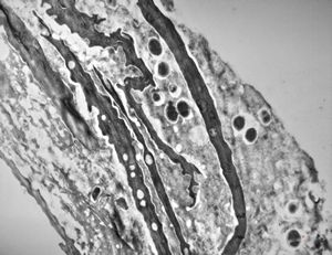 M,68y. | auditory meatus … otitis externa mycotica M,68y. | auditory meatus … otitis externa mycotica